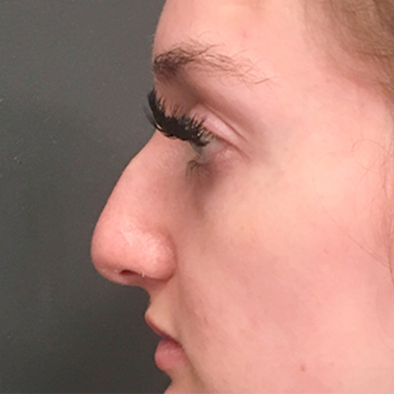 Rhinoplasty 05