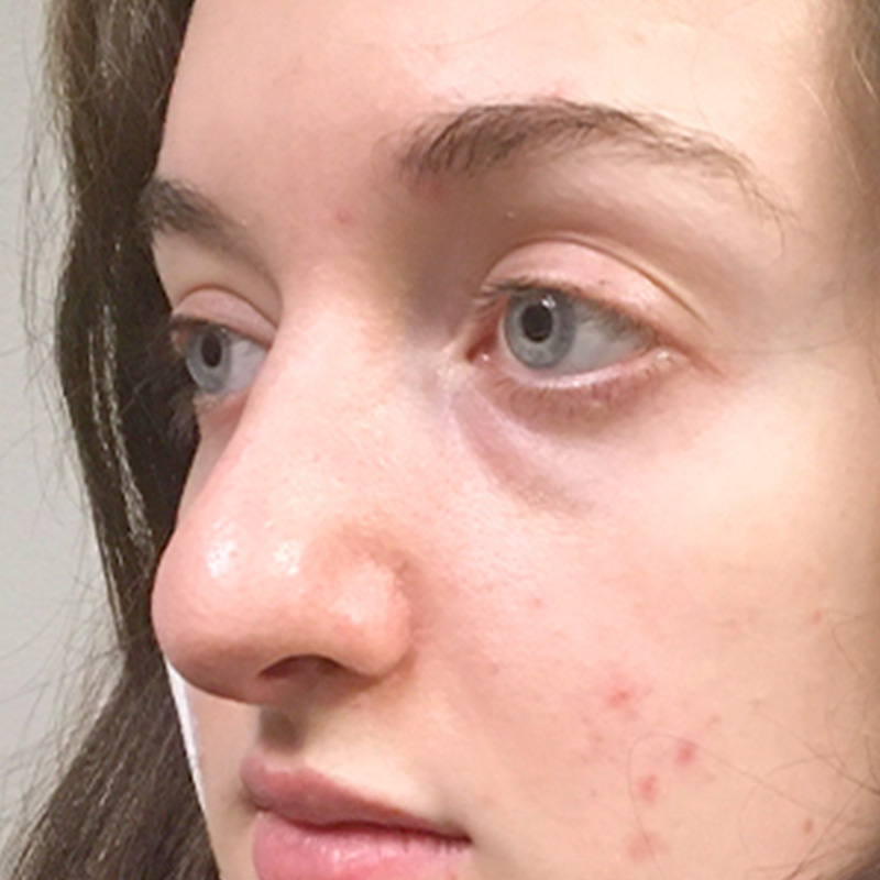 Rhinoplasty 07