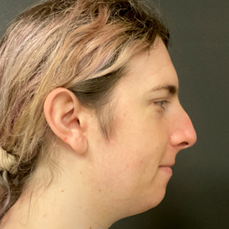 Rhinoplasty 05