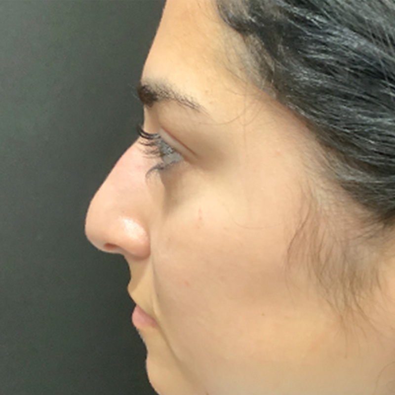Rhinoplasty 01