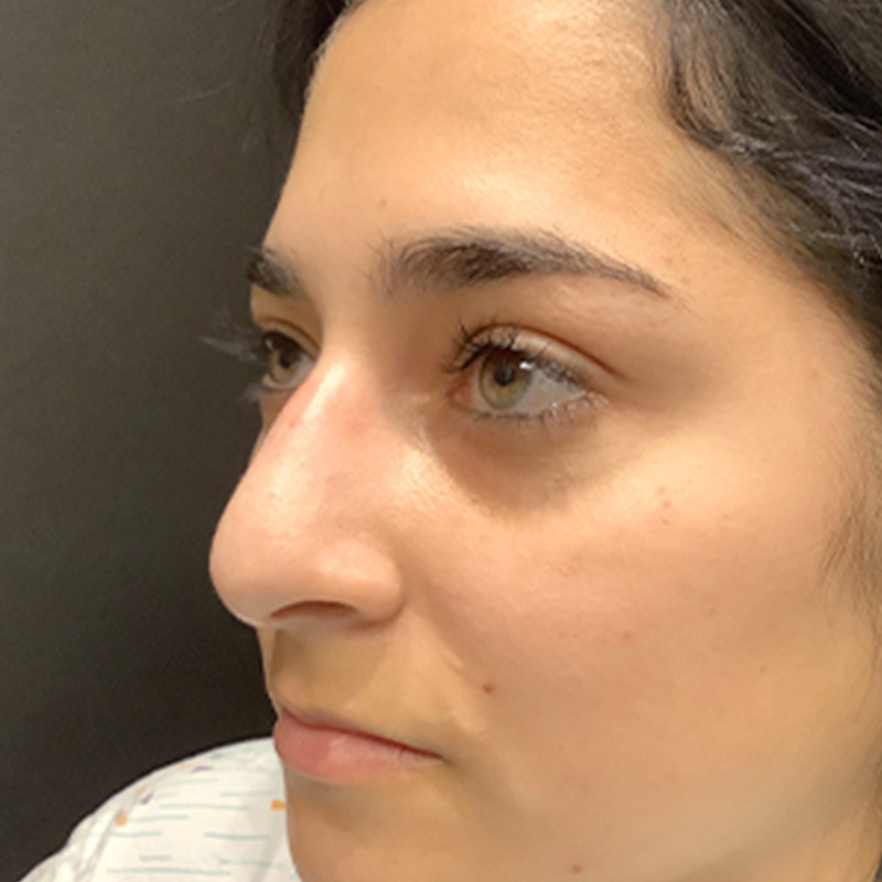 Rhinoplasty 03