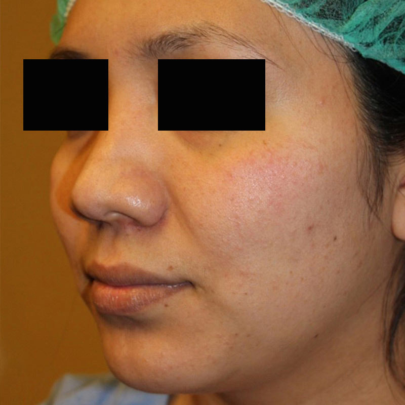 Rhinoplasty 03