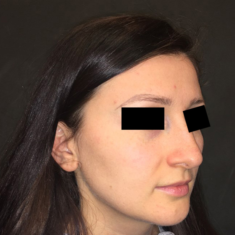 Rhinoplasty 07