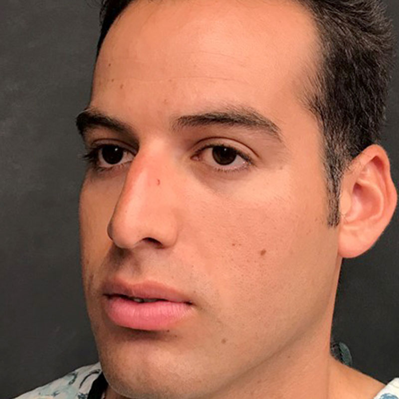 Rhinoplasty 03