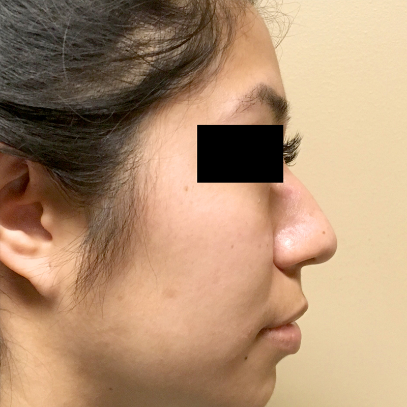 Rhinoplasty 01