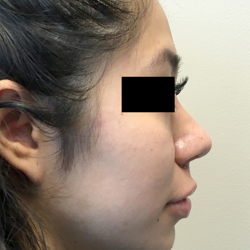 Rhinoplasty 18