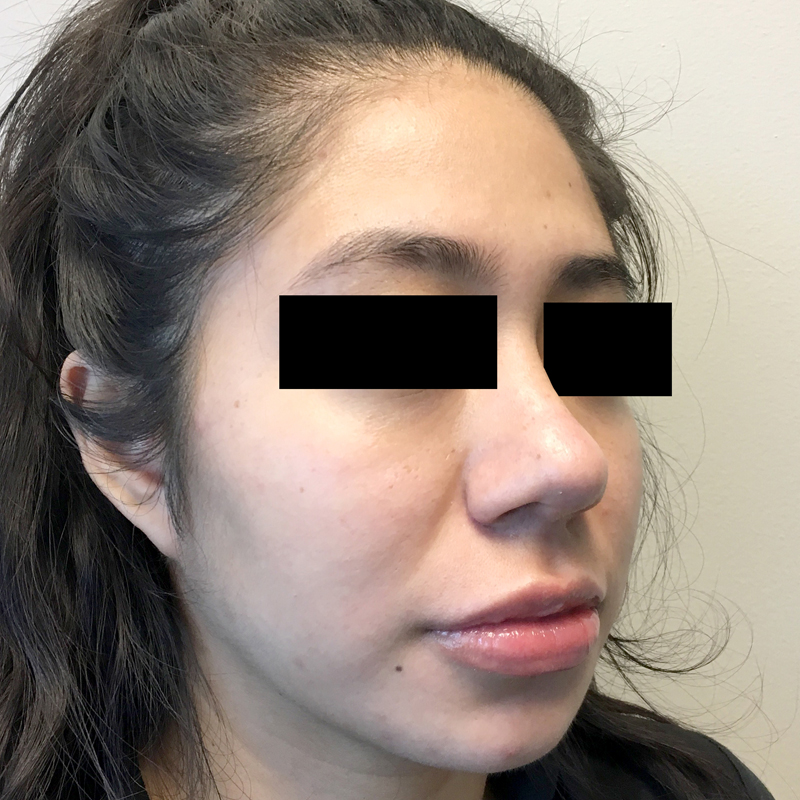 Rhinoplasty 03