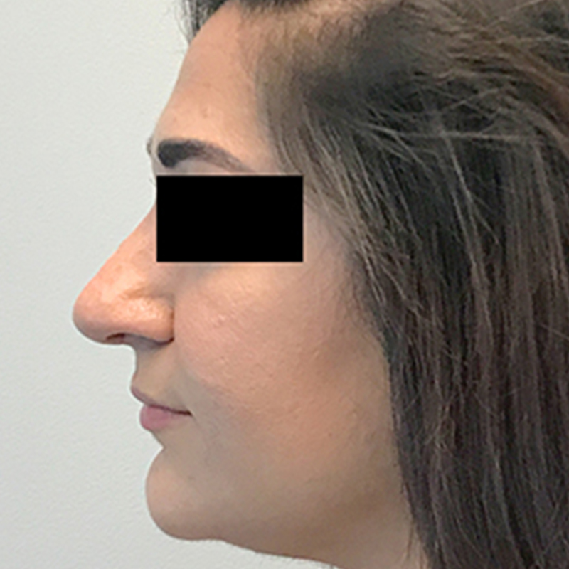 Rhinoplasty 05