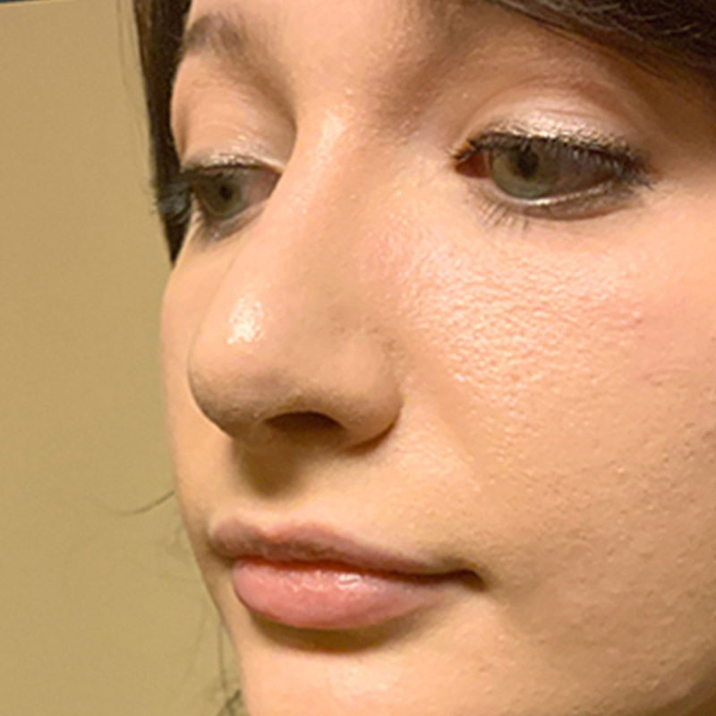 Rhinoplasty 03