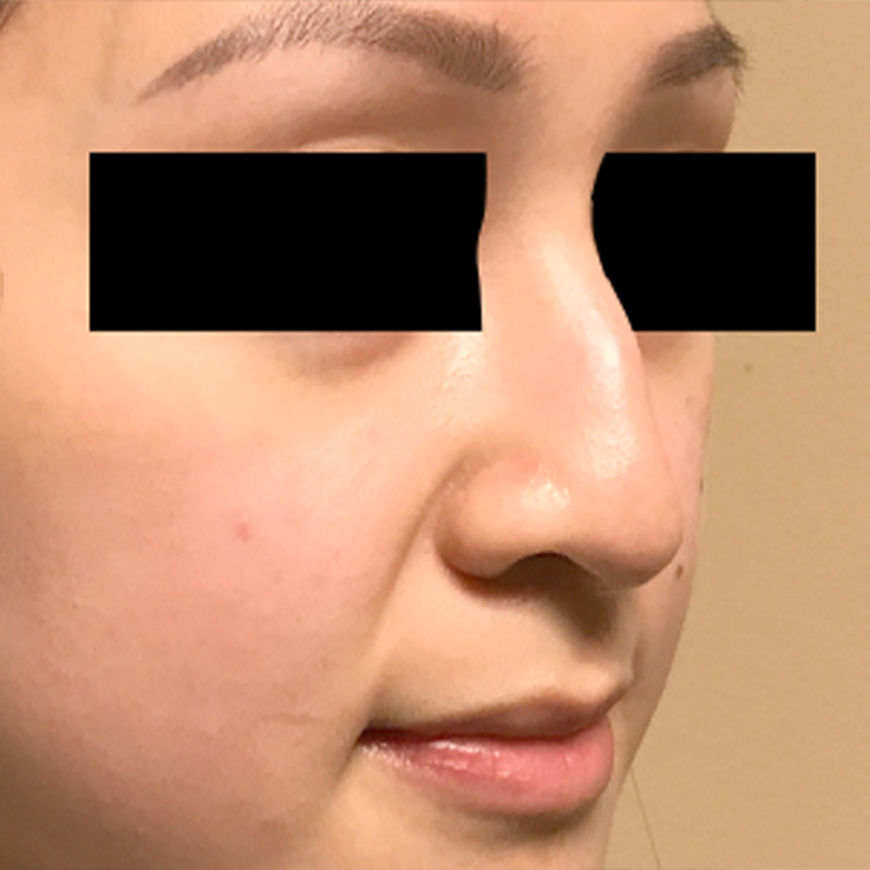 Rhinoplasty 03