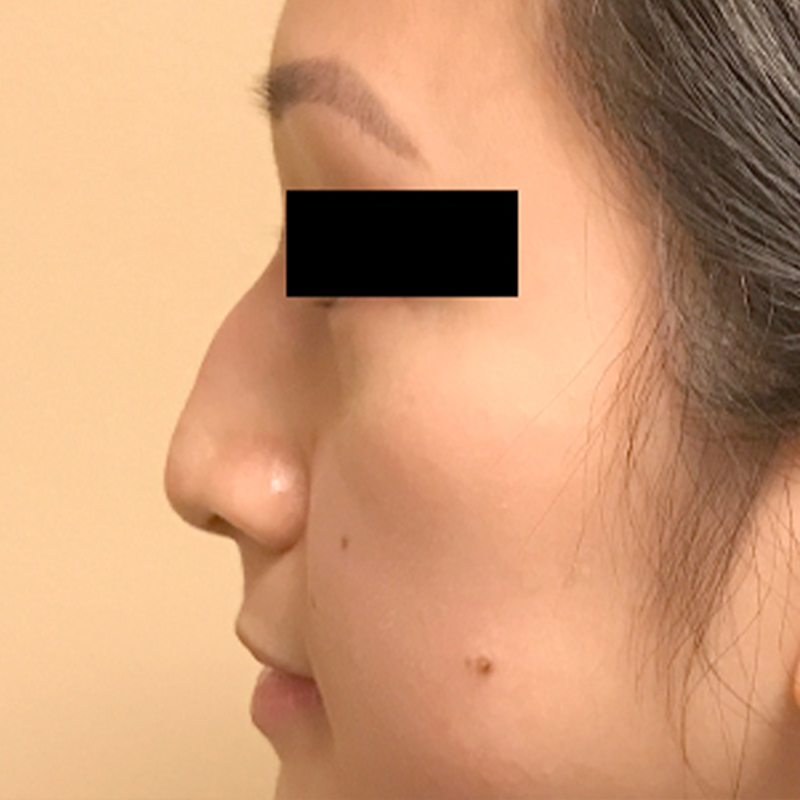 Rhinoplasty 09