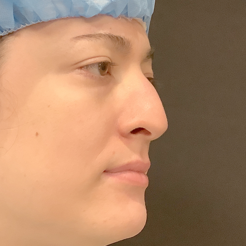 Rhinoplasty 01