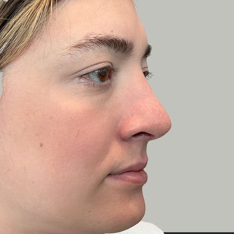 Rhinoplasty 25