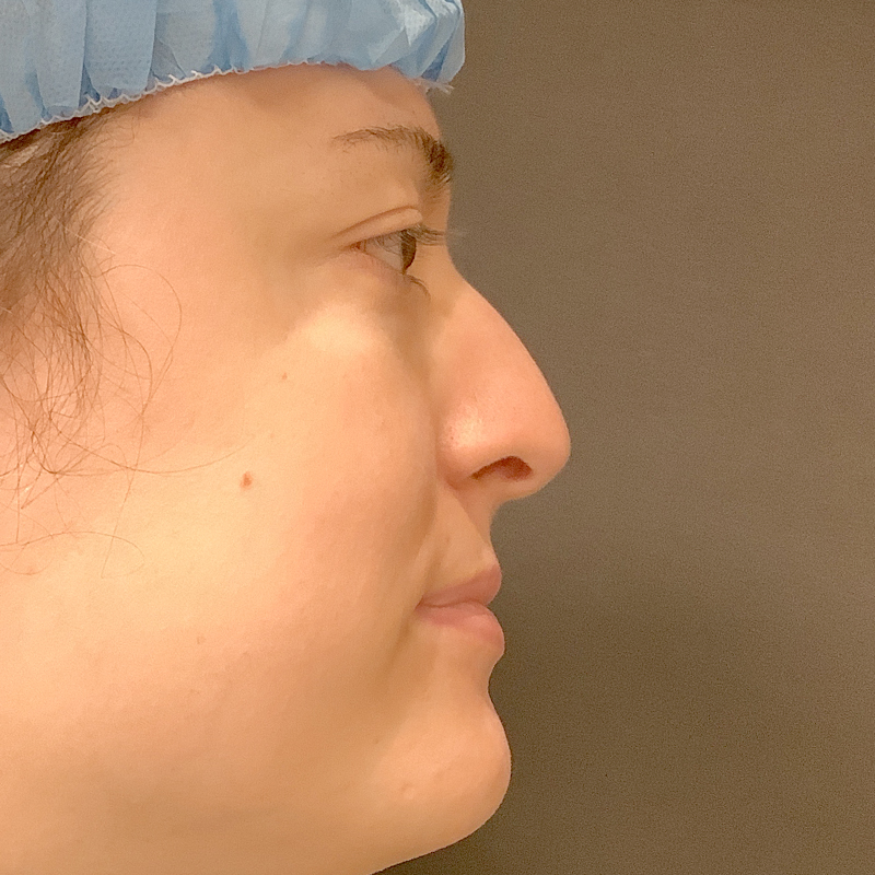 Rhinoplasty 03