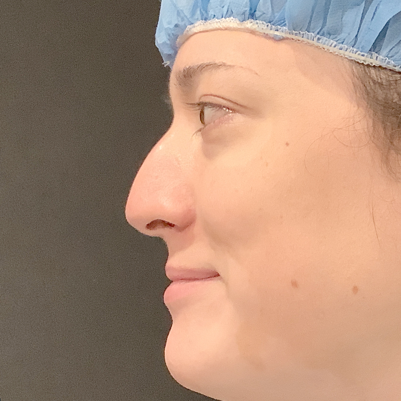 Rhinoplasty 15