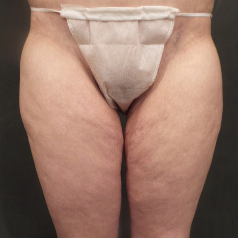 Thigh Lift 01
