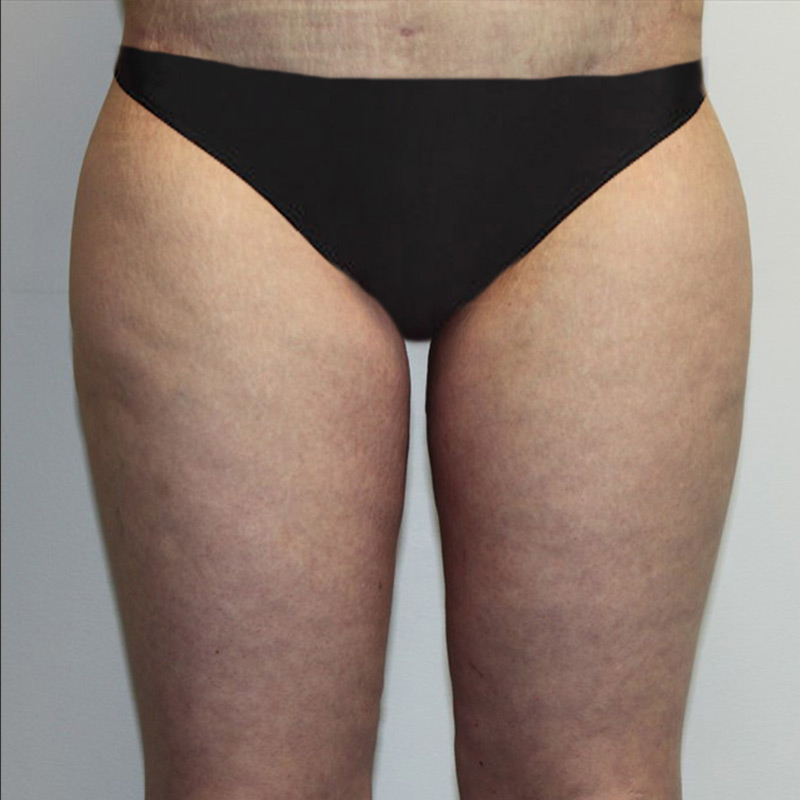 Thigh Lift 01