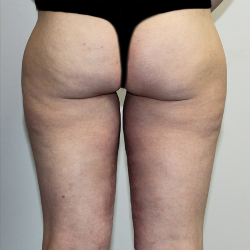 Thigh Lift 07