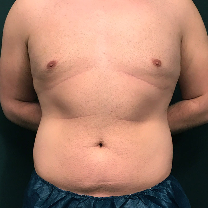 Vaser Liposuction 01