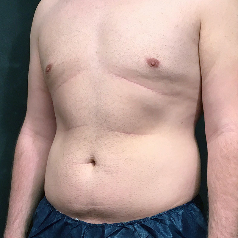 Vaser Liposuction 03