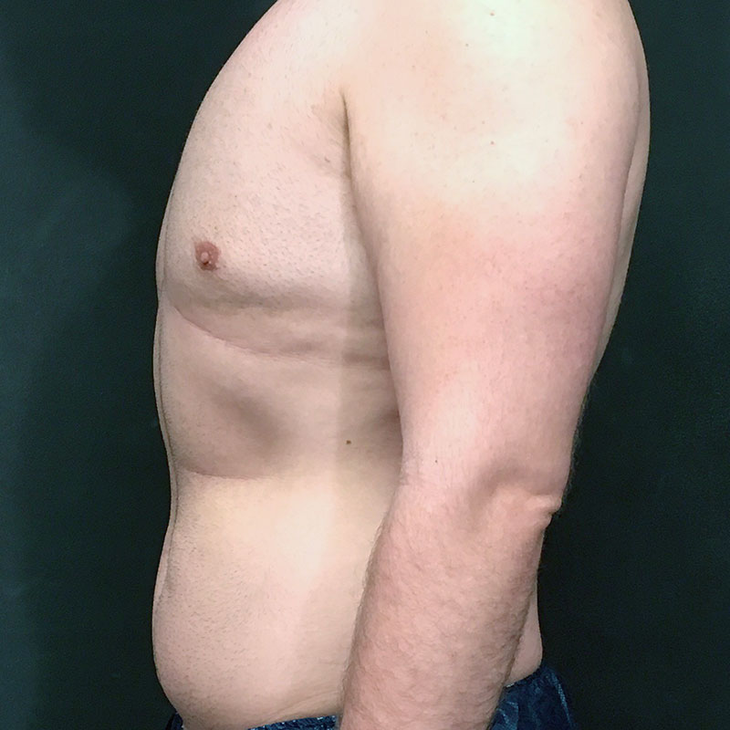 Vaser Liposuction 05