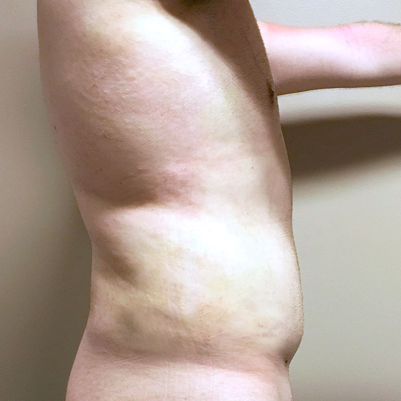 Vaser Liposuction 09