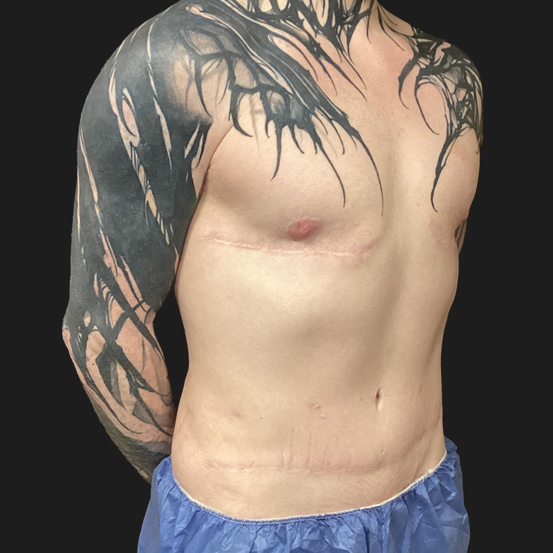 Abdominal Etching 01