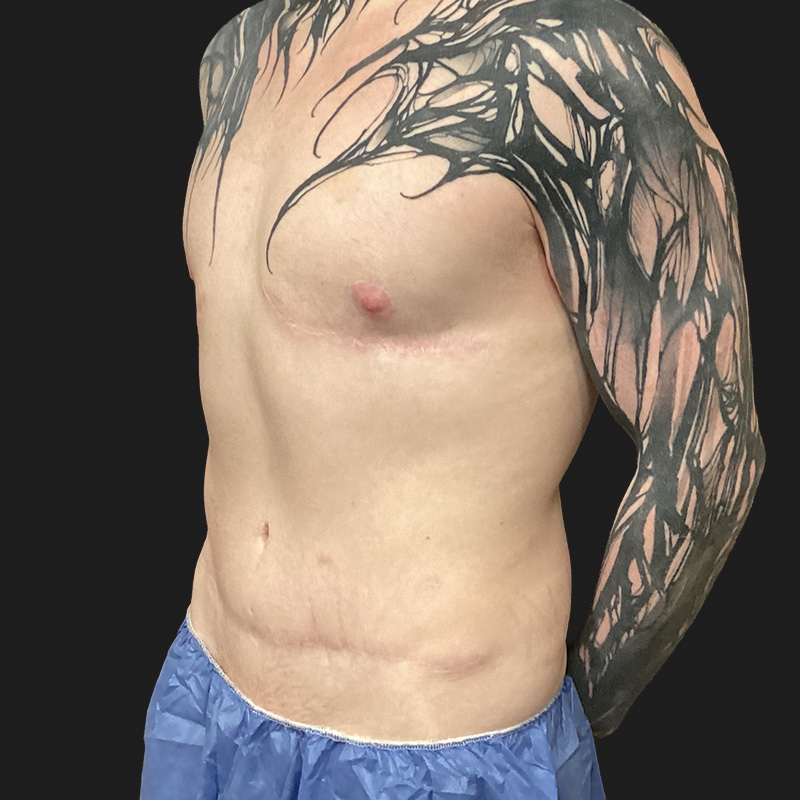 Abdominal Etching 03