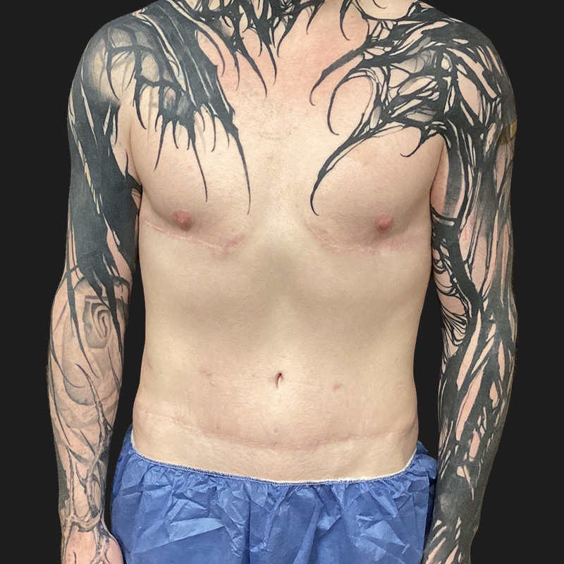 Abdominal Etching 05