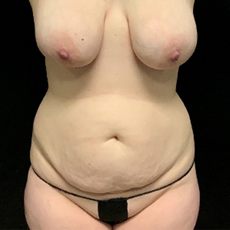 Combining a Tummy Tuck With a BBL