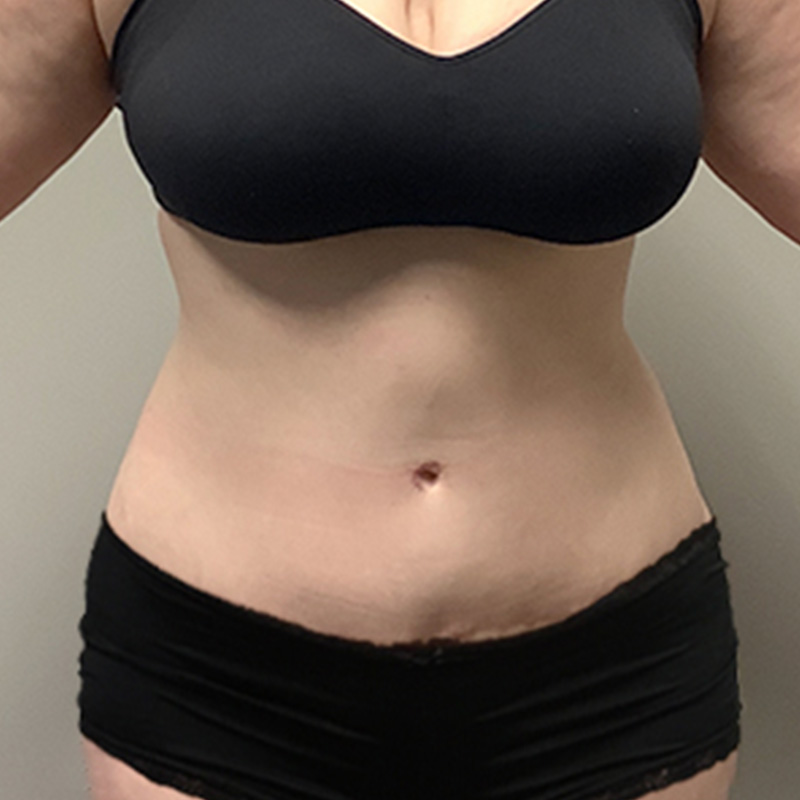Combining a Tummy Tuck With a BBL