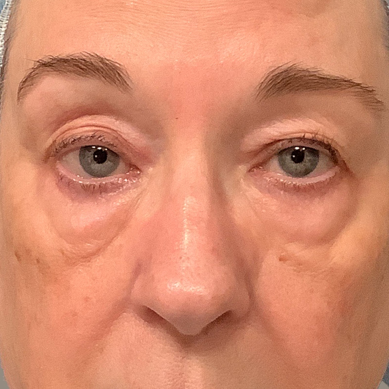 Eyelid Surgery Before and After Photos by Joshua Cooper, MD; Seattle, WA -  Case 41869 - ASPS