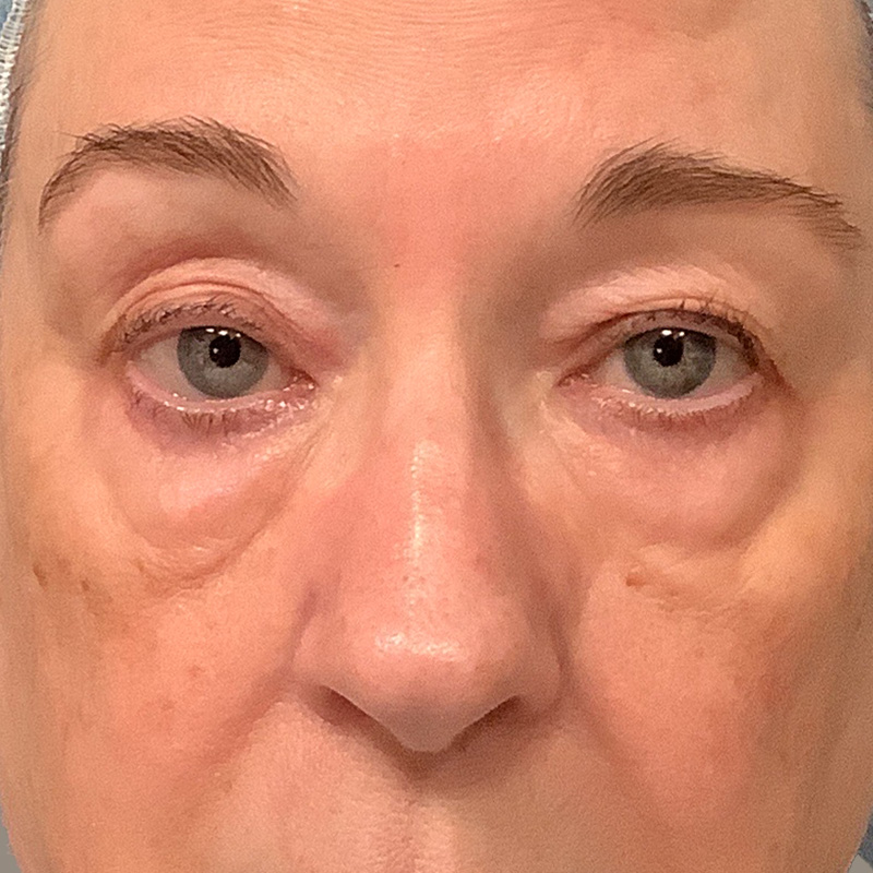 Blepharoplasty Bellevue - Eyelid Surgery Seattle