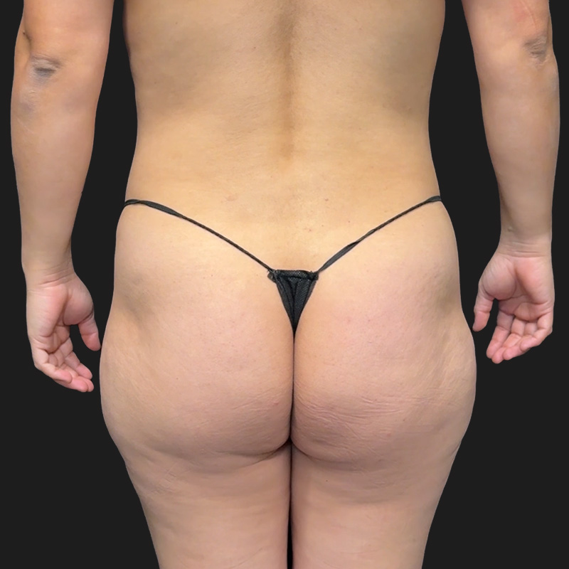 Brazilian Butt Lift 01
