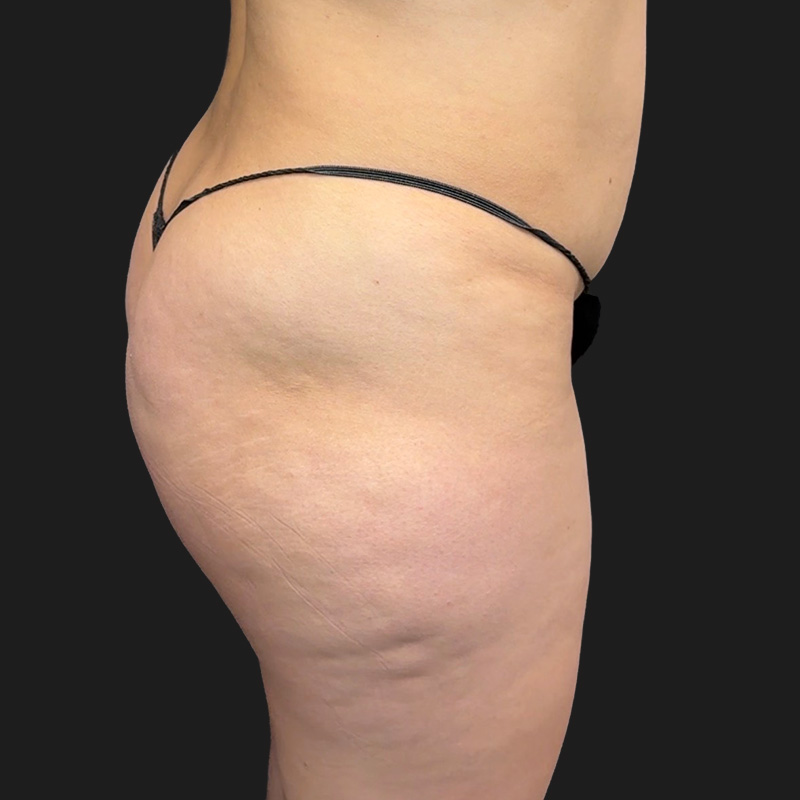 Brazilian Butt Lift 03
