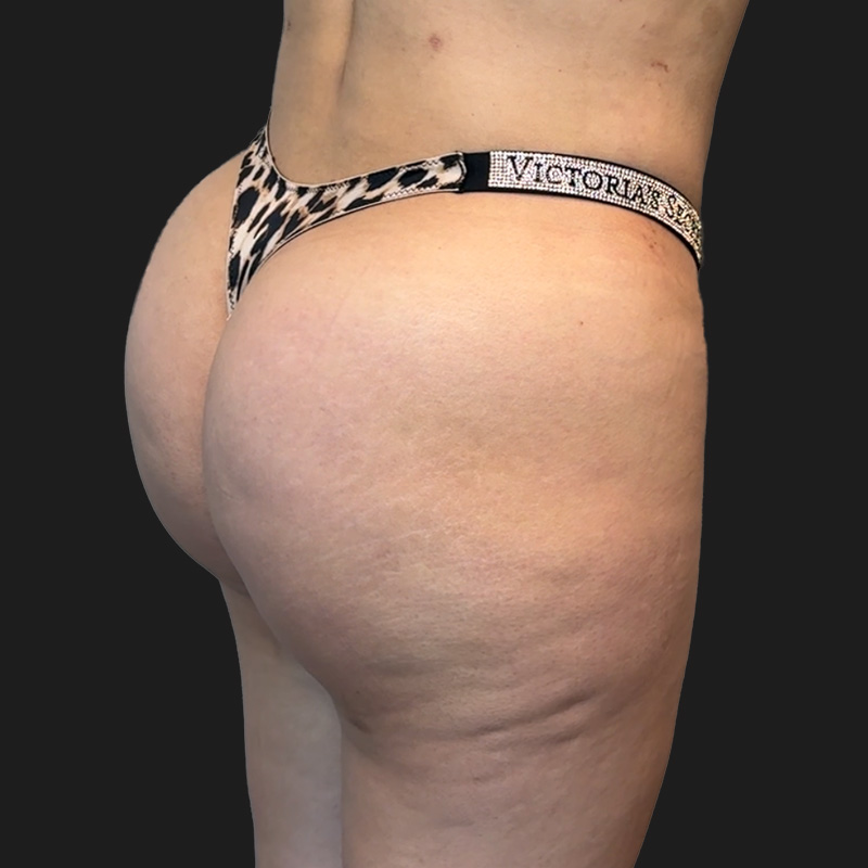 Brazilian Butt Lift 03