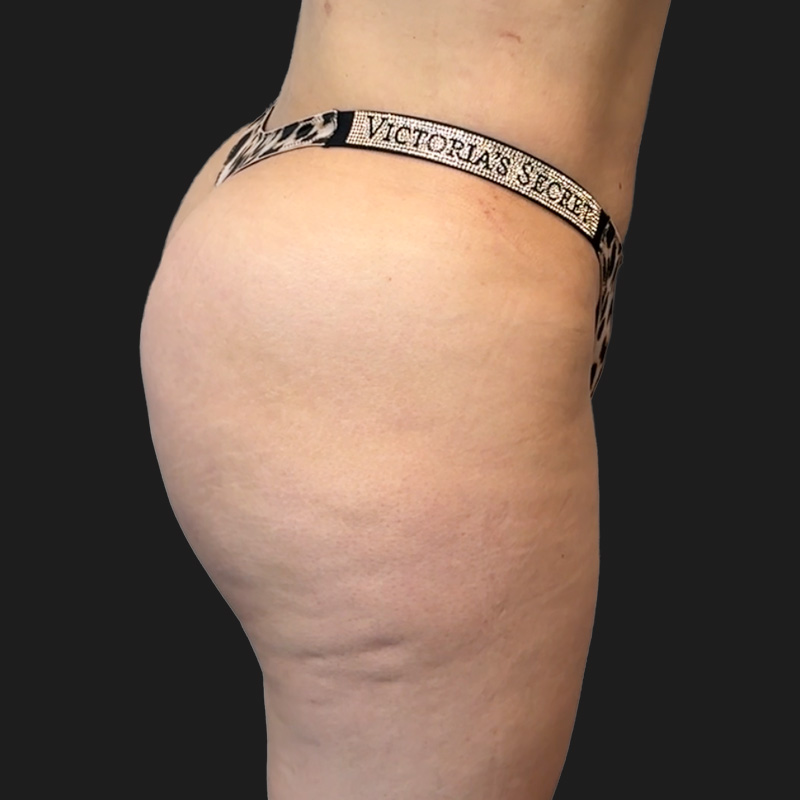 Brazilian Butt Lift 05