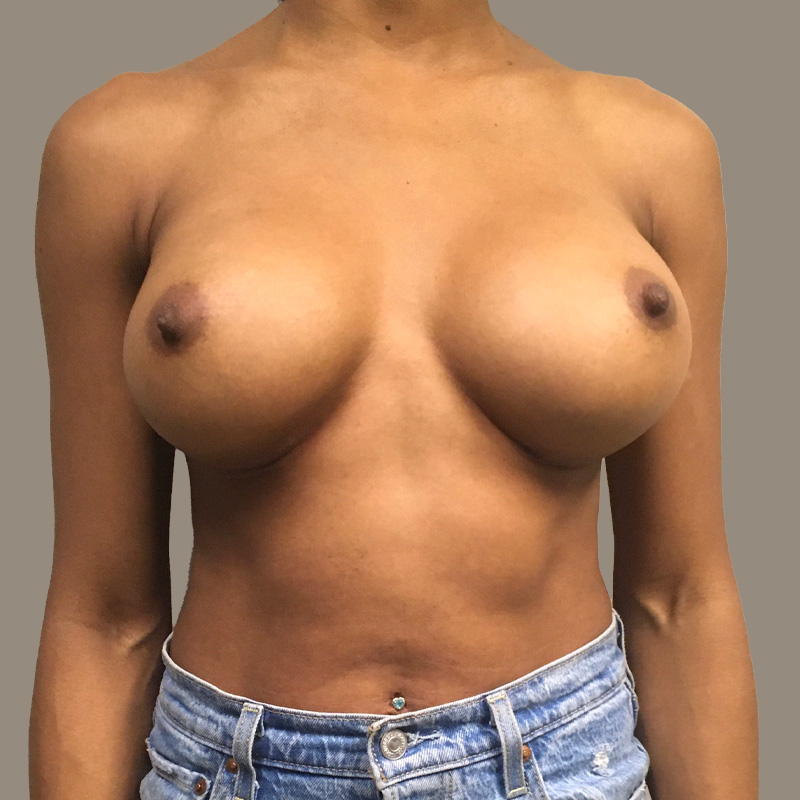 Breast Augmentation Seattle