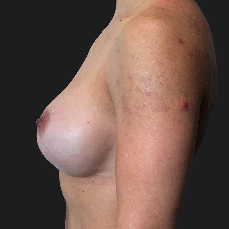 Breast Augmentation 145