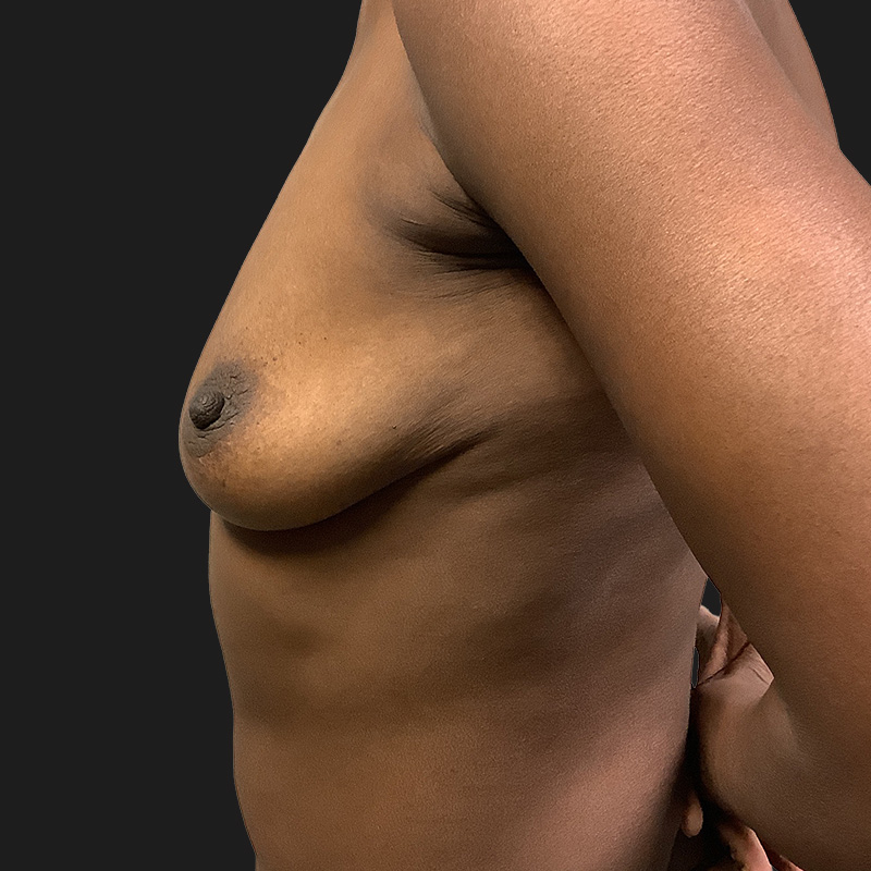 Breast Augmentation 03