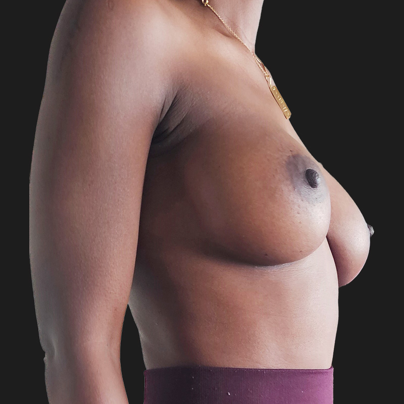 Breast Augmentation 05