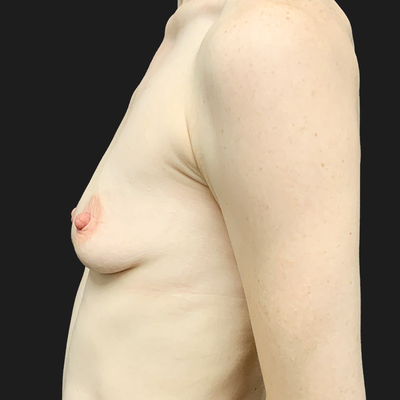 Breast Augmentation 03