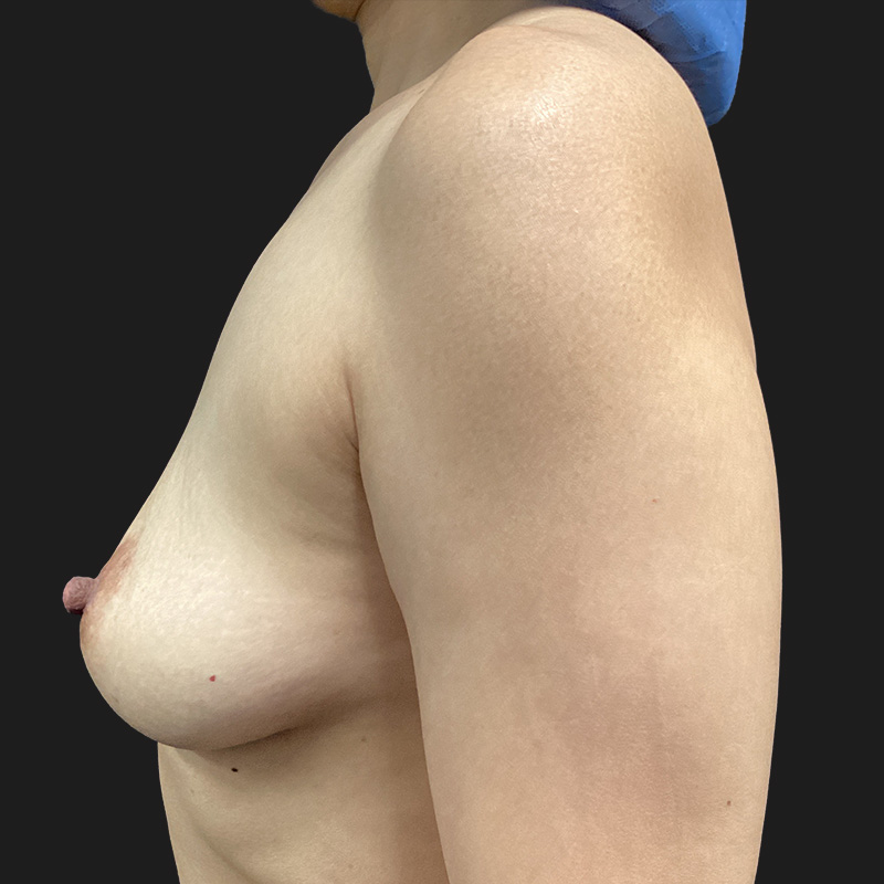 Breast Augmentation 03