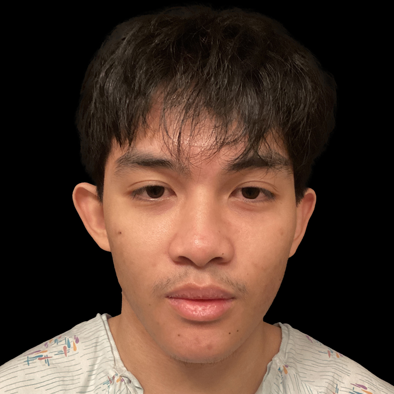 Extended Bilateral Otoplasty 01