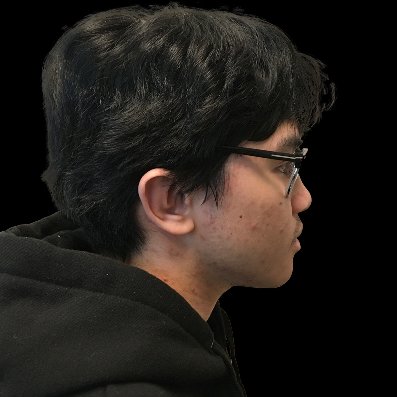 Extended Bilateral Otoplasty 03