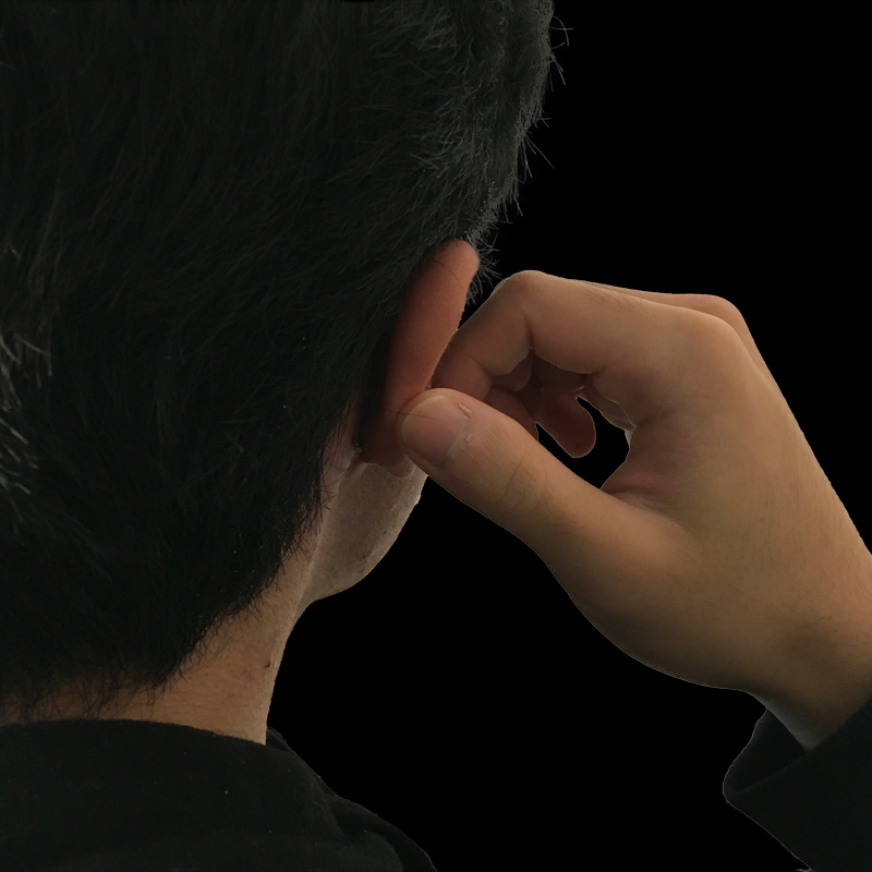 Extended Bilateral Otoplasty 05