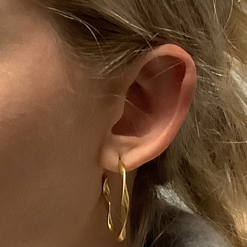 Extended Bilateral Otoplasty 03