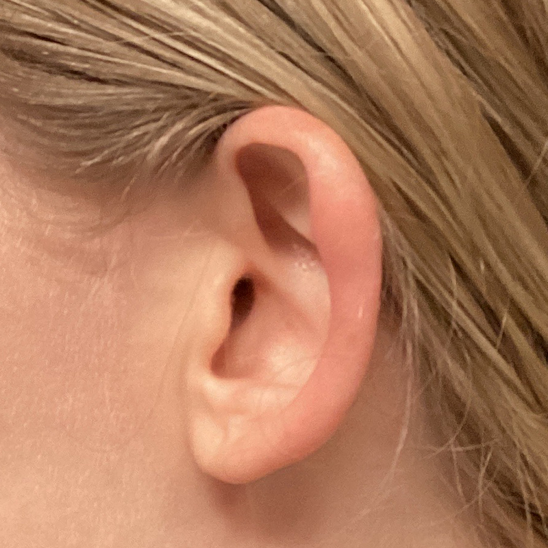 Extended Bilateral Otoplasty 05