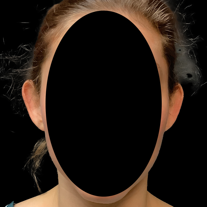 Extended Bilateral Otoplasty 01