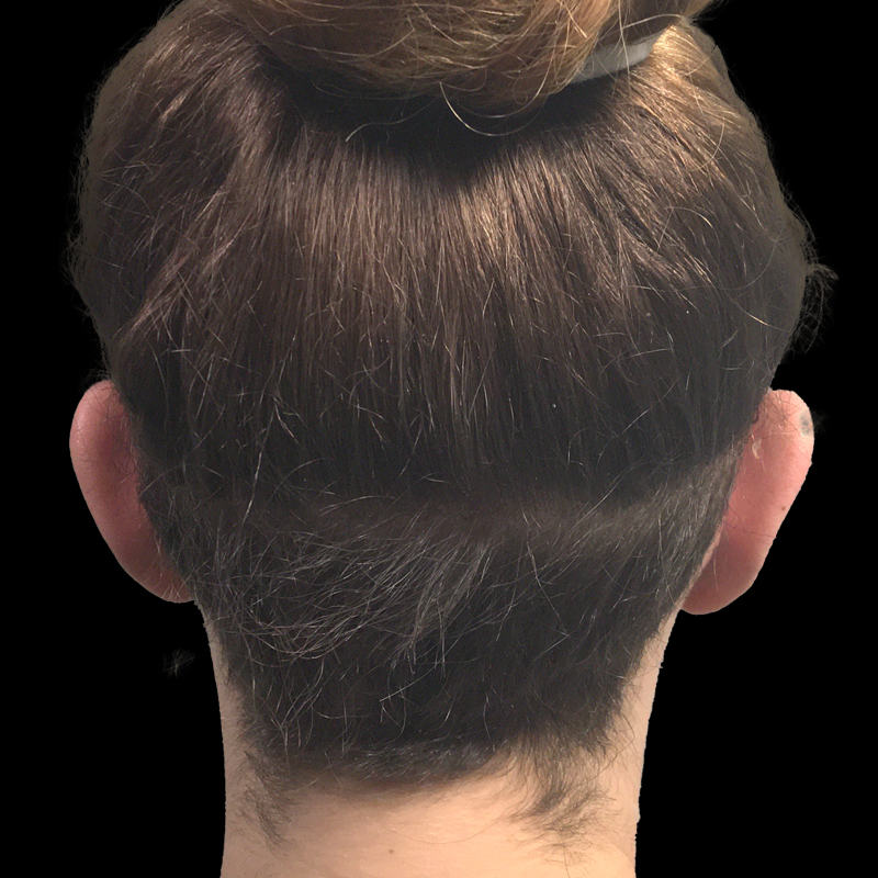 Extended Bilateral Otoplasty 03